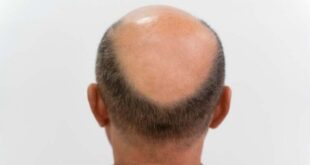 Cara Menumbuhkan Rambut Botak di Usia Muda