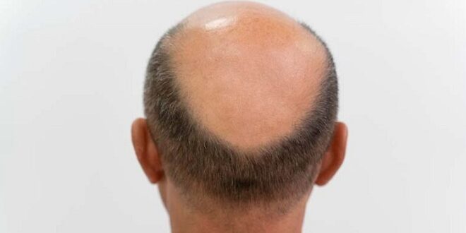 Cara Menumbuhkan Rambut Botak di Usia Muda